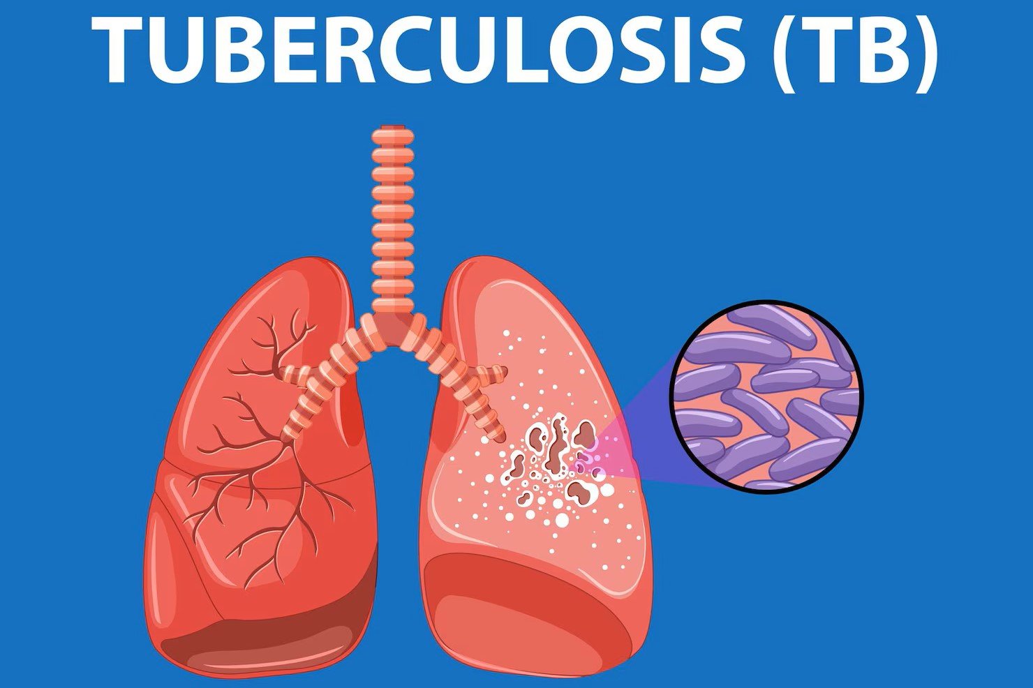 Tuberculosis (T. B.)
